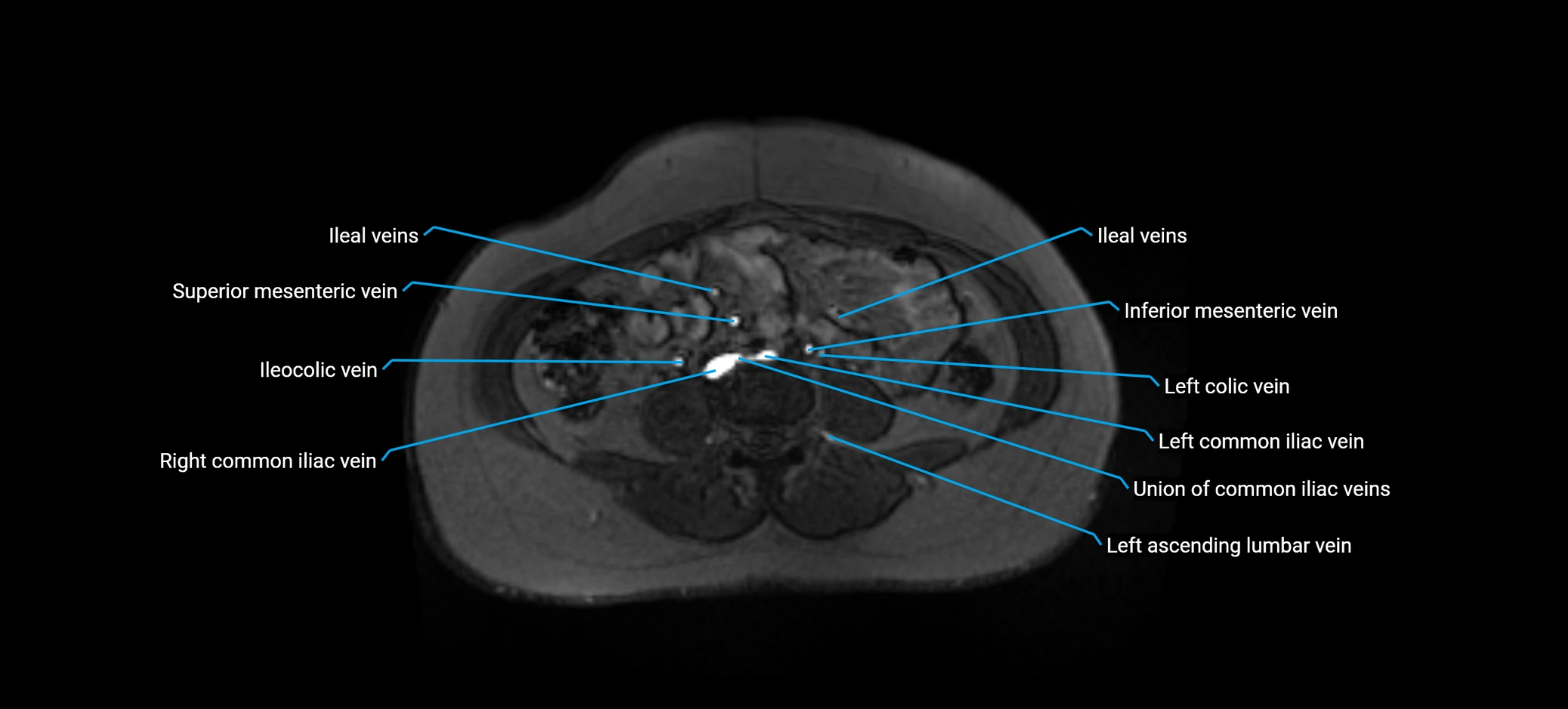 MRV abdomen pelvis & lower limb axial cross sectional anatomy labelled MRI image 110 (1).webp